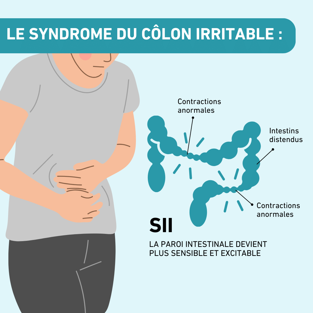 syndrome du colon irritable SII